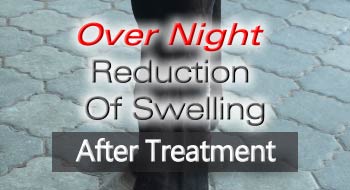 VET Sonotron Mark2 Produces Overnight Reduction Of Swelling At SDF Tendon Of Racehorse After Treatment